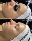 Purify - Korean Acne Facial Treatment