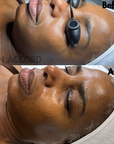 PLLA Korean Volume Facial w/ Stem Cell Mist Home Kit