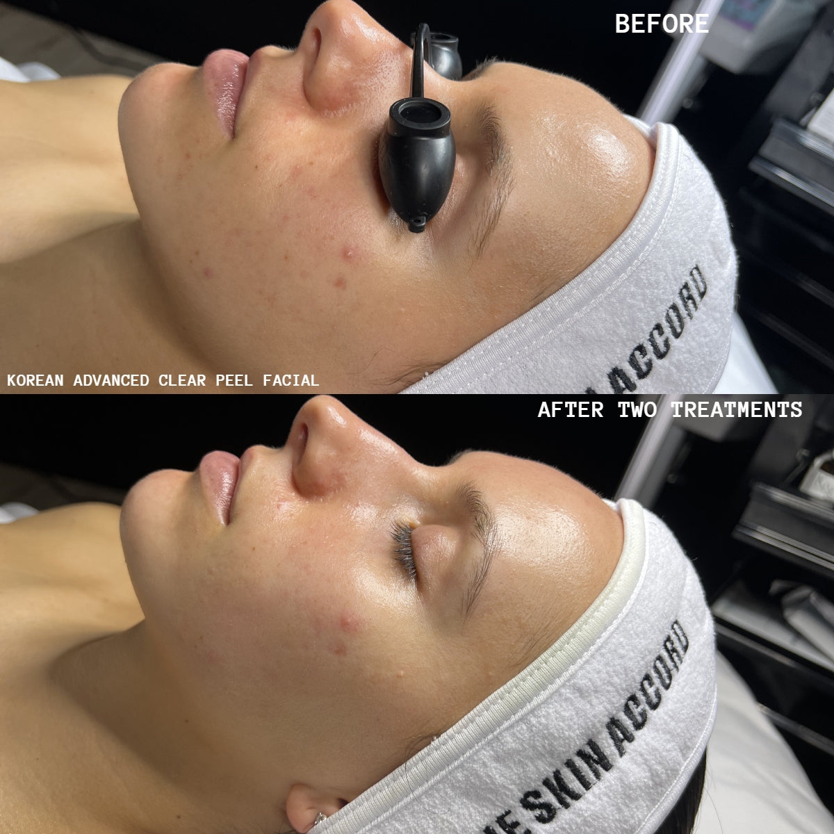 Purify - Korean Acne Facial Treatment