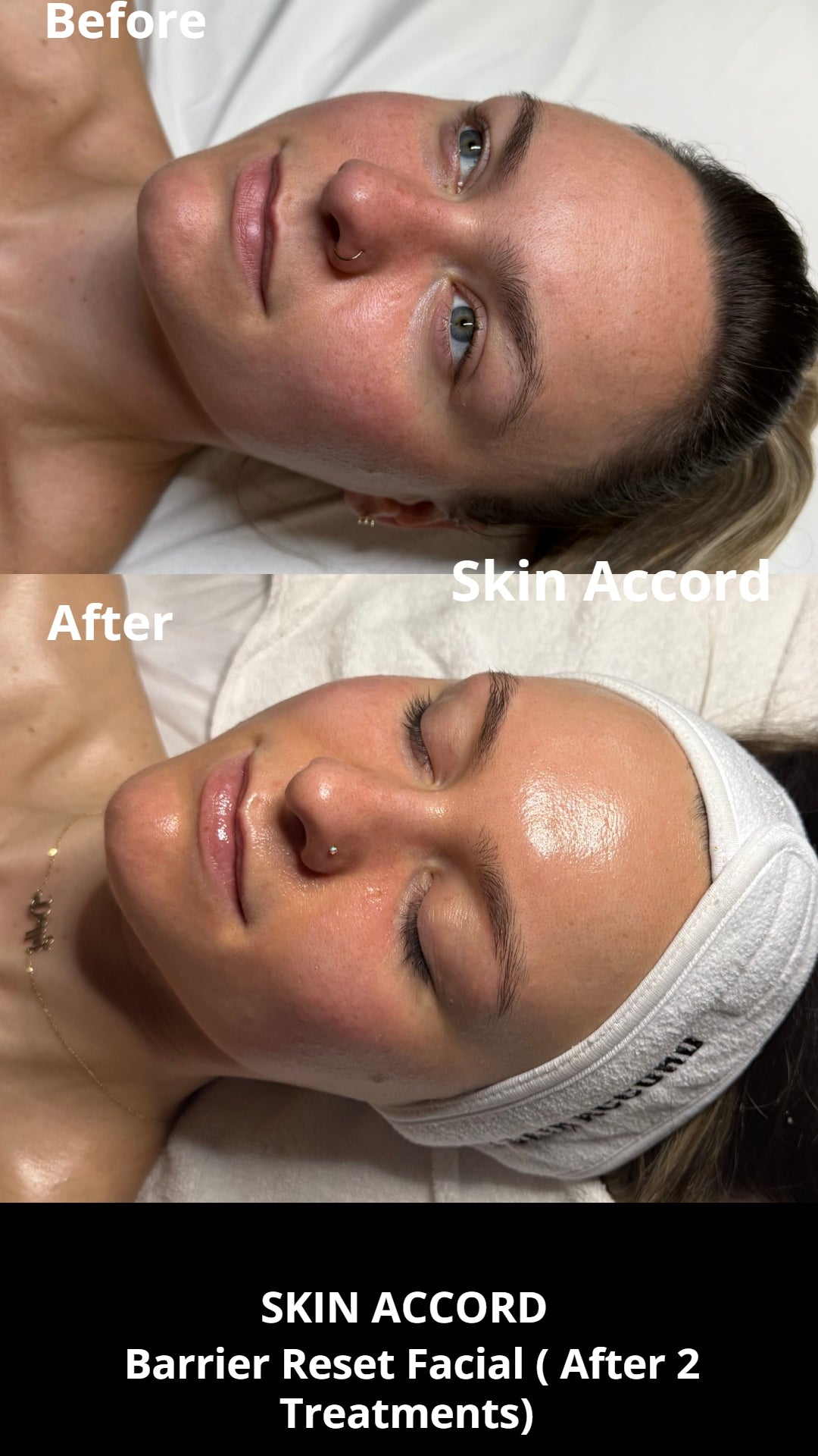 Barrier Reset - Intro Facial