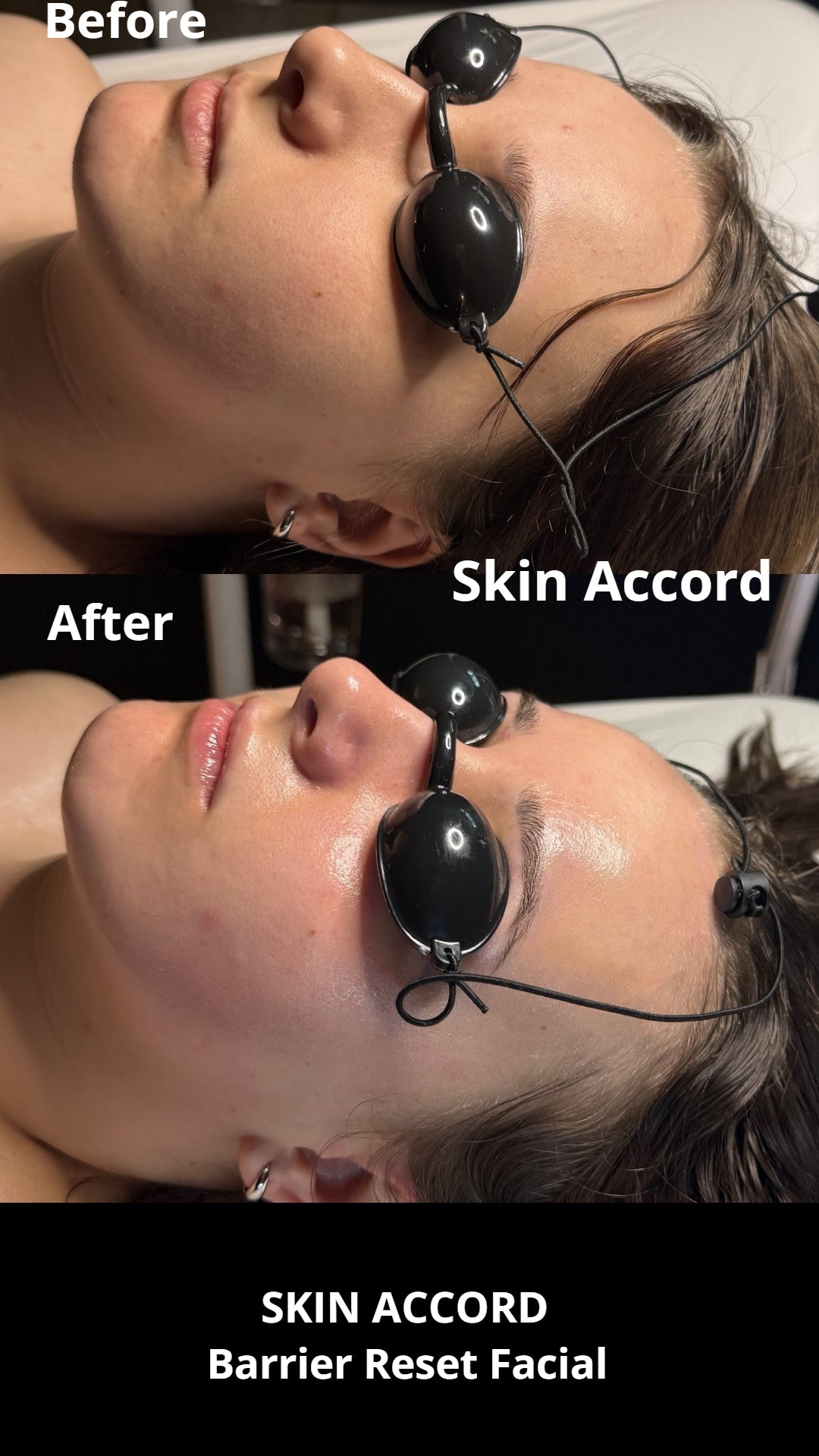 Barrier Reset - Intro Facial