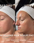 PLLA Korean Sculpt Facial (PLLA MIni)