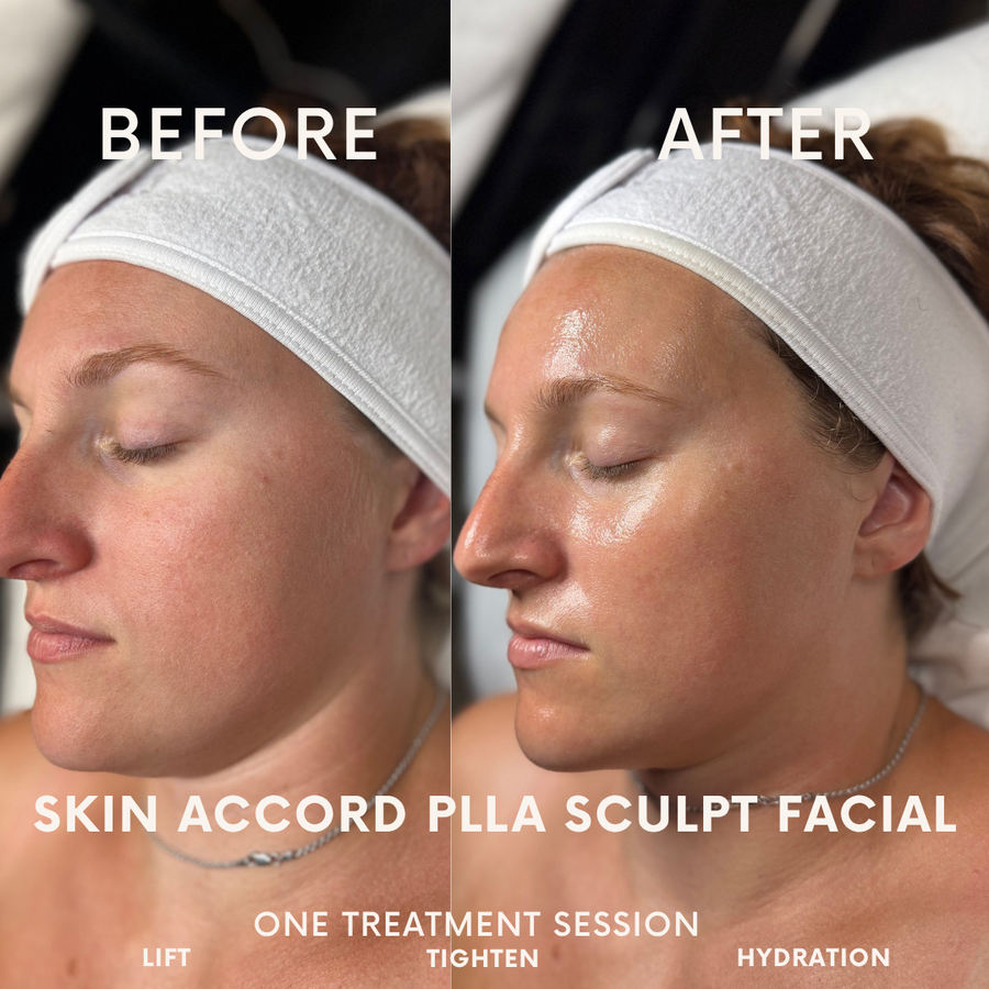 PLLA Korean Sculpt Facial (PLLA MIni)