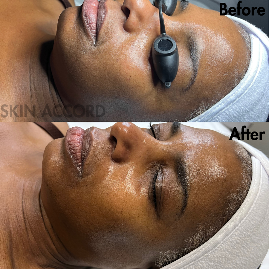 PLLA Korean Volume Facial