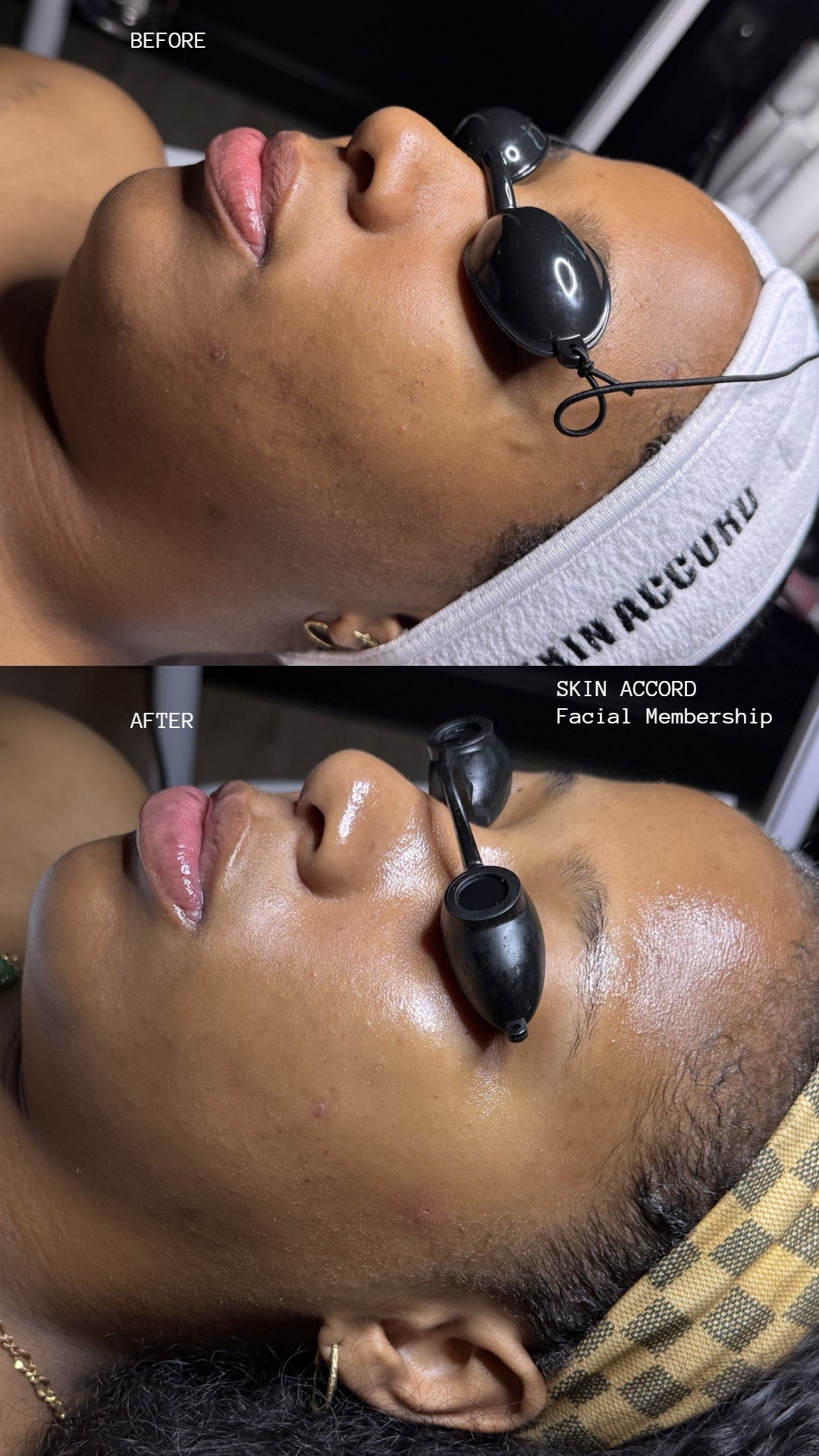 Skin Accord Korean Treatment Membership