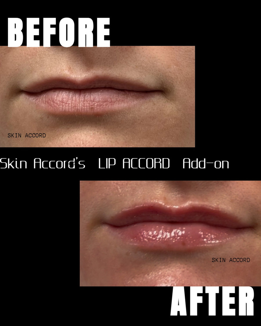 Microderm Enzyme Facial