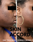 Perfect Derma Peel