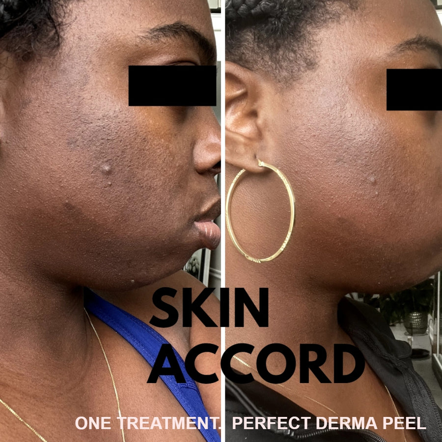Perfect Derma Peel