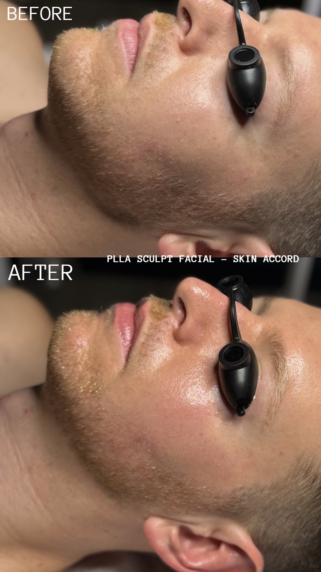 Skin Accord Korean Treatment Membership