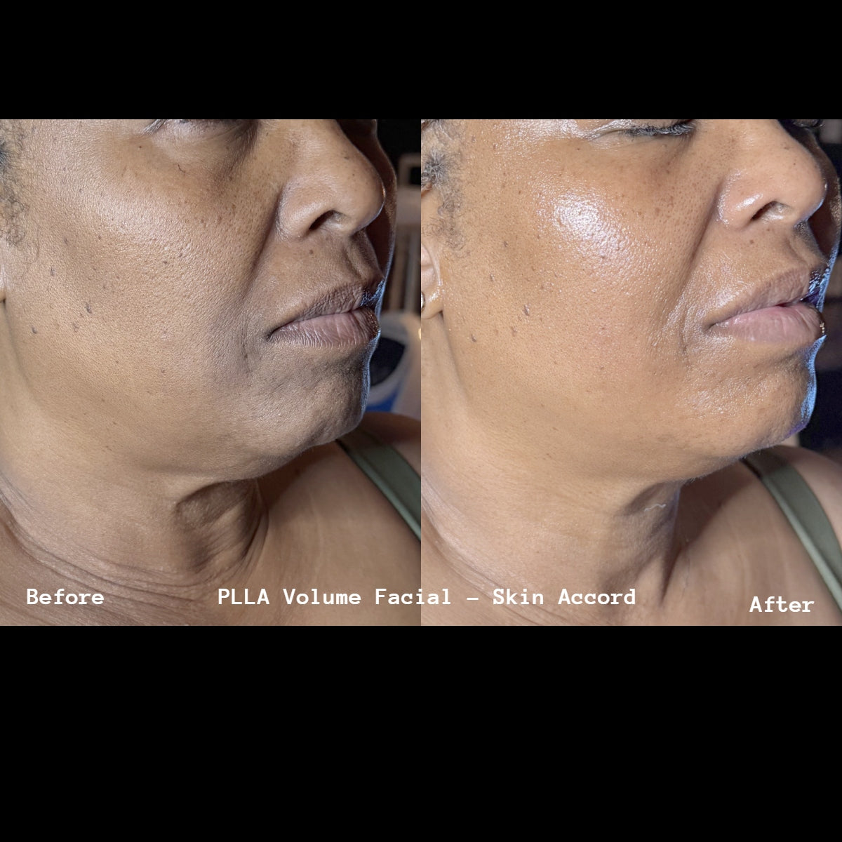 PLLA Korean Volume Facial w/ Stem Cell Mist Home Kit