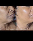 PLLA Korean Volume Facial w/ Stem Cell Mist Home Kit