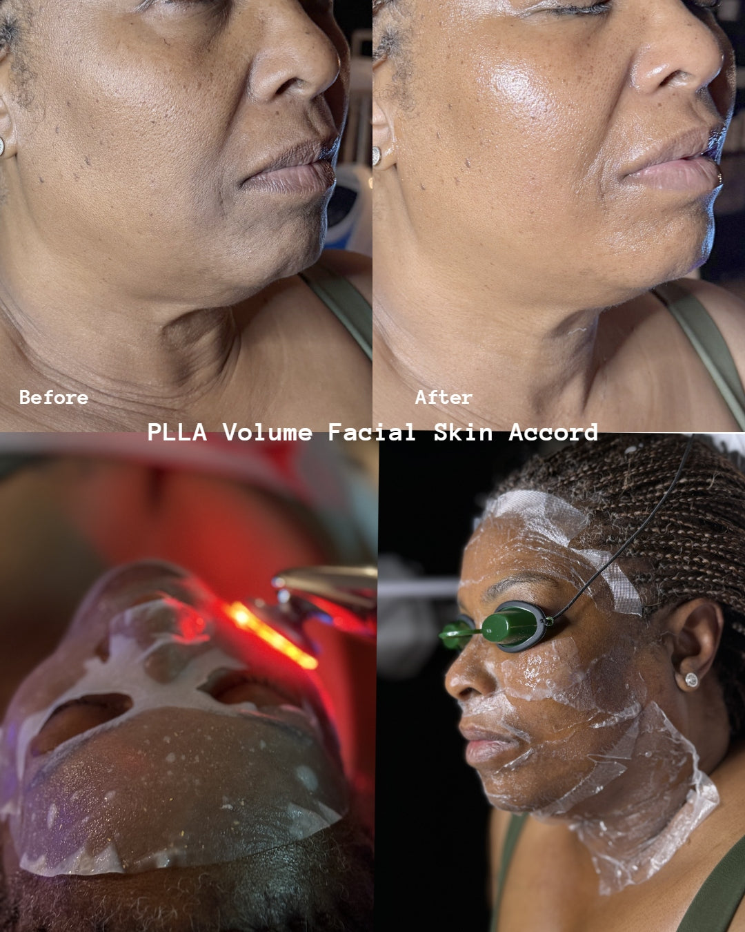 PLLA Korean Volume Facial w/ Stem Cell Mist Home Kit
