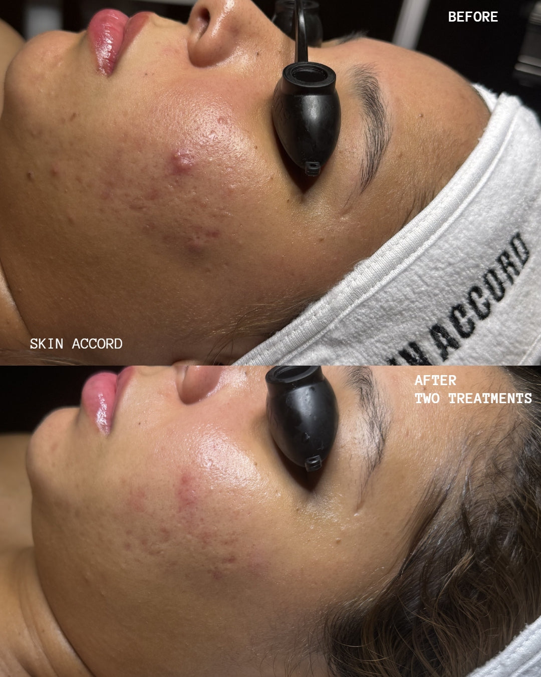 Purify - Korean Acne Facial Treatment