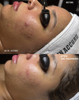 Purify - Korean Acne Facial Treatment