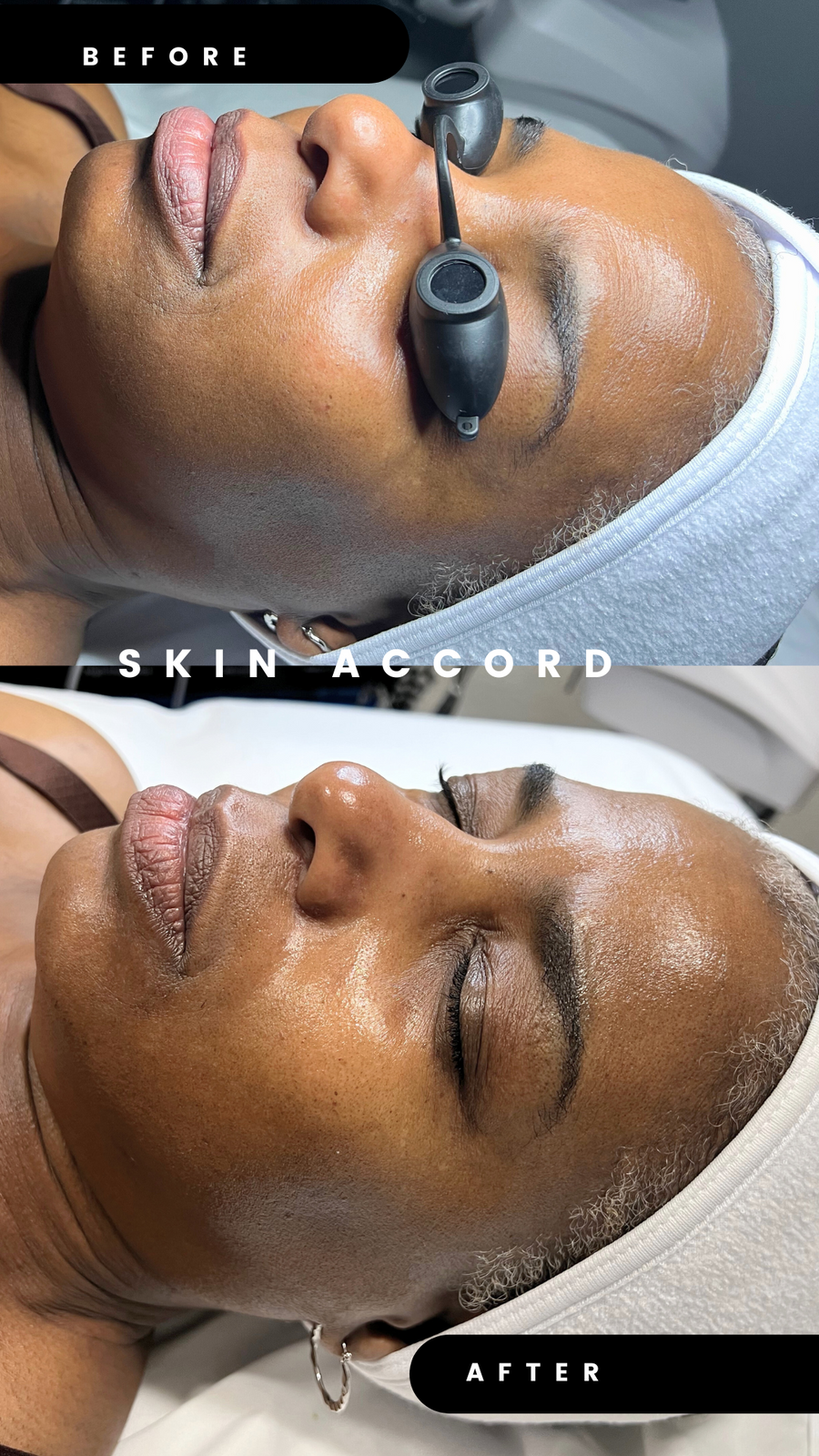 PLLA Korean Facial Mini