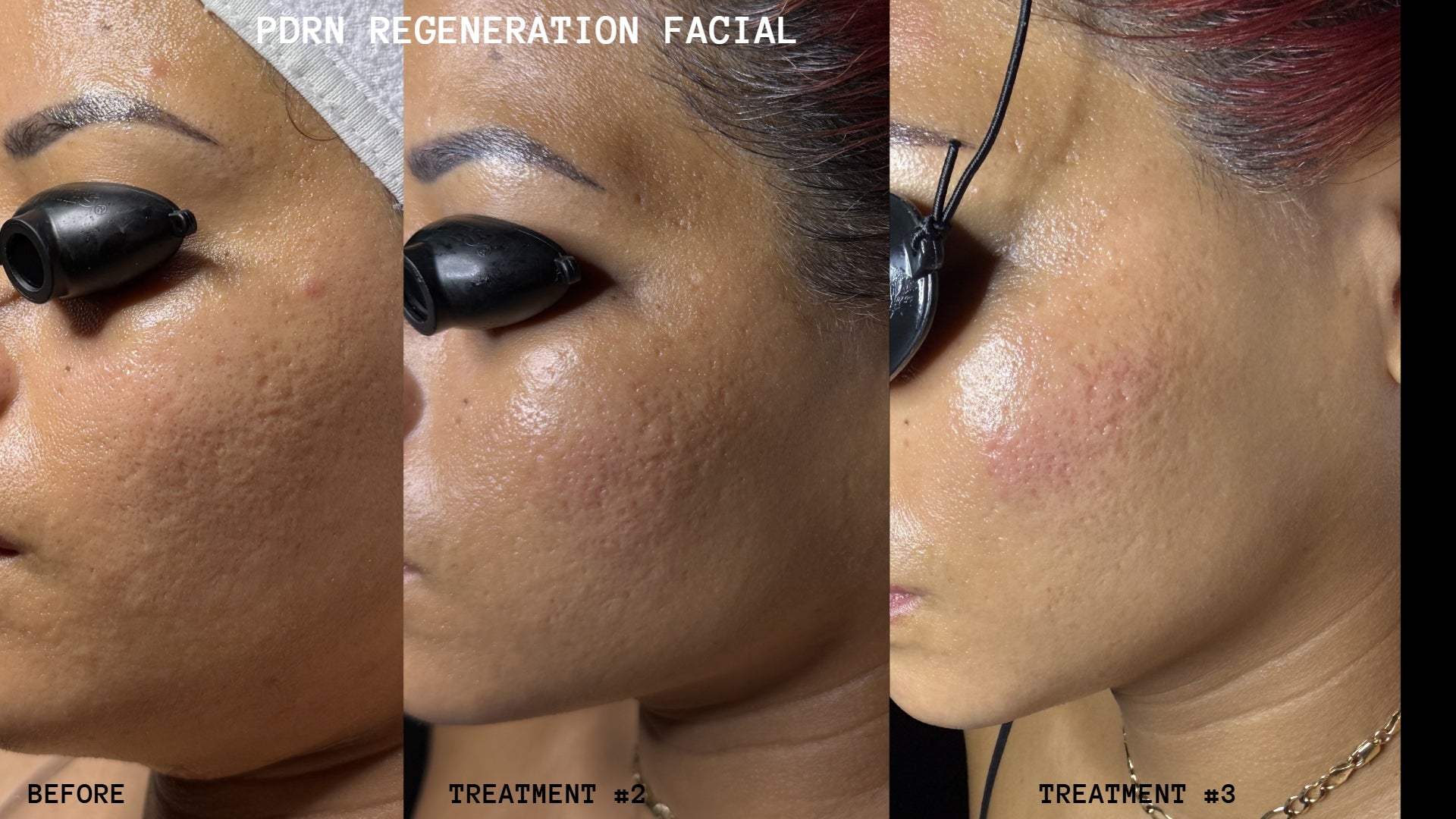 PDRN Regeneration Facial