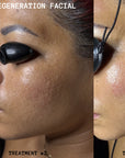 PDRN Regeneration Facial