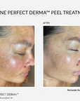 Perfect Derma Peel