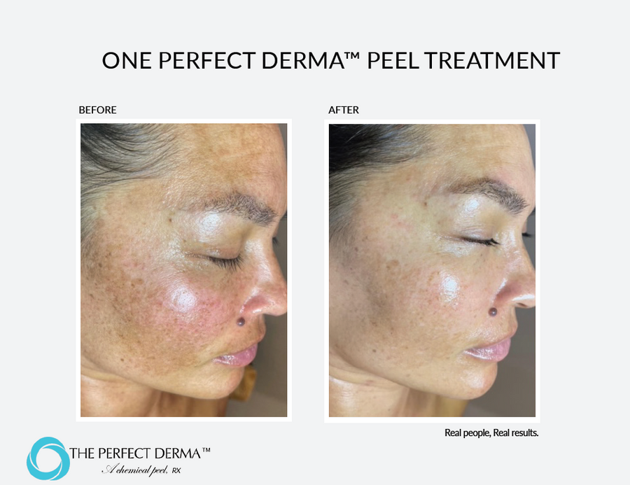 Perfect Derma Peel