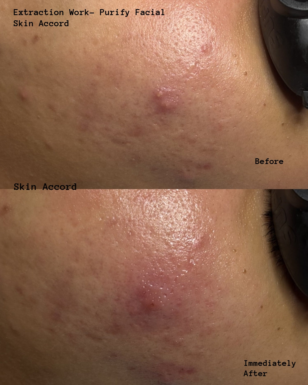 Purify - Korean Acne Facial Treatment