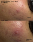 Purify - Korean Acne Facial Treatment