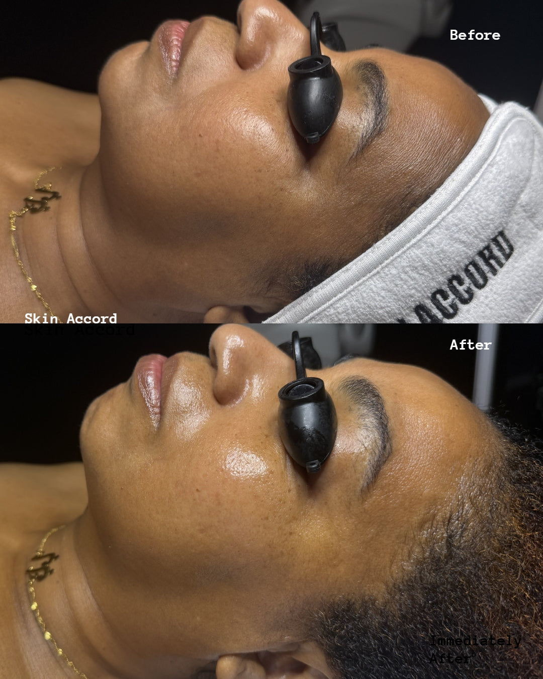 Skin Accord Peel Program
