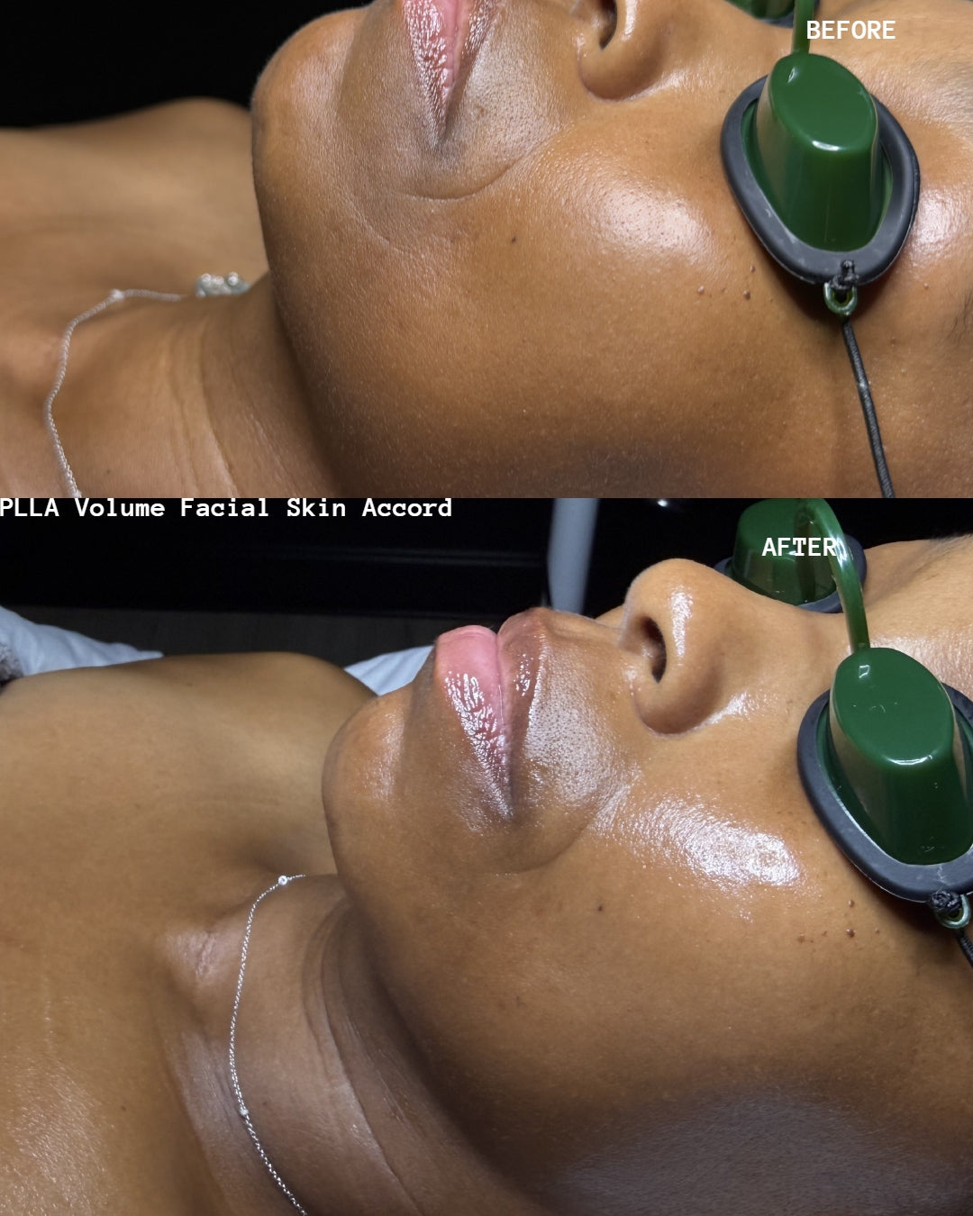 PLLA Korean Volume Facial w/ Stem Cell Mist Home Kit