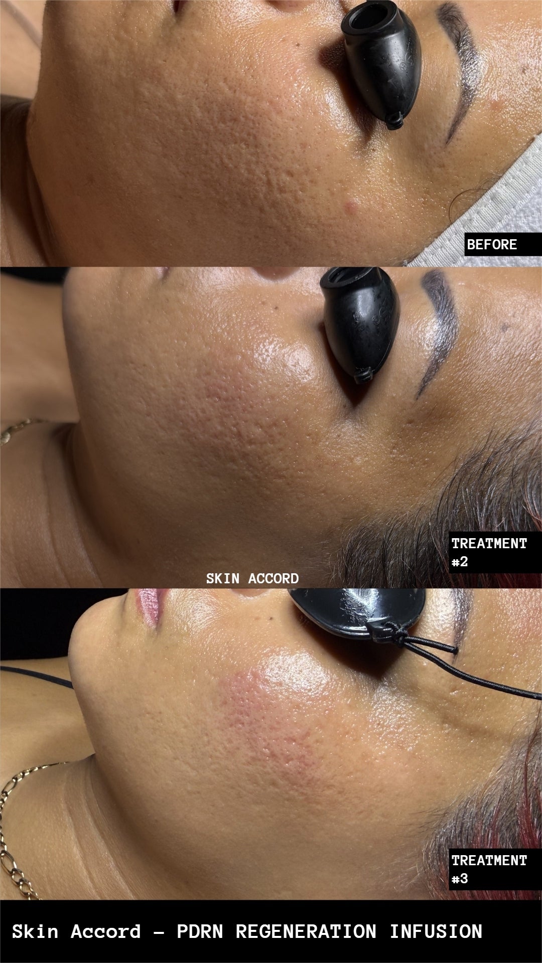 PDRN Regeneration Facial