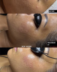 PDRN Regeneration Facial
