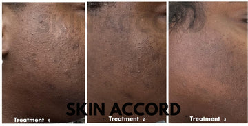 Advanced Treatment - Three Acid Free Organic Chemical Exfoliation Treatments (3 Treatments included)