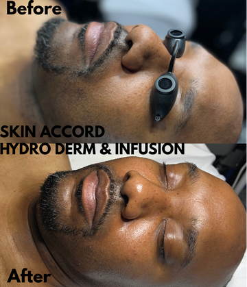Advanced Treatment - Hydro Derm & Infusion Treatment