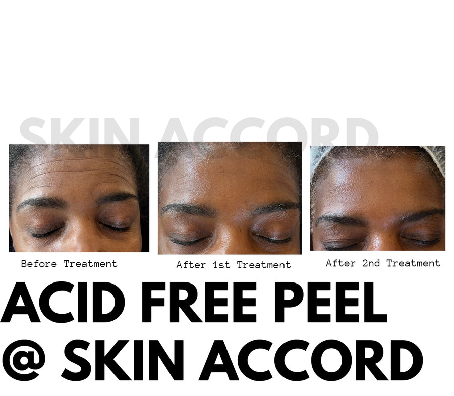 Advanced Treatment - Acid Free Organic Chemical Exfoliation Treatment (1 Treatment)